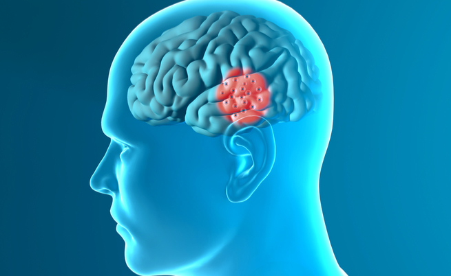 Cura per il Parkinson: la terapia potrebbe arrivare da un farmaco per il diabete