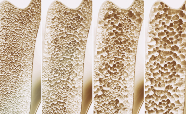 osteoporosi: sintomi e definizione