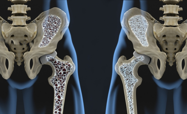 Cos'è l'osteoporosi? Quali sono i sintomi? Vediamolo insieme!