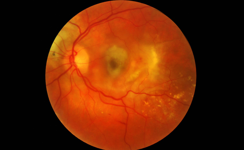 maculopatia: cosa è