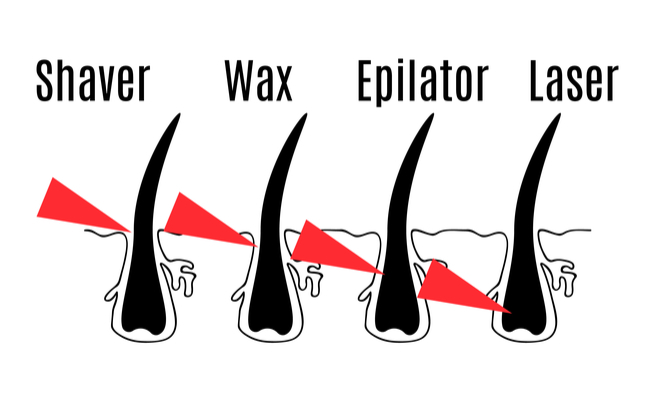 Epiliazione definitiva: ecco come agiscono le diverse tipologie