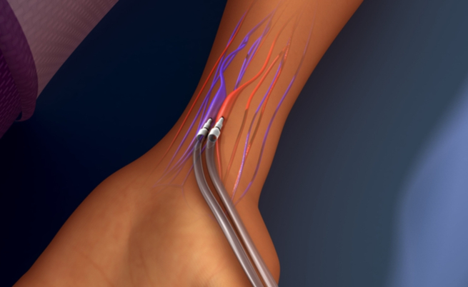 Le complicanze della fistola arterovenosa