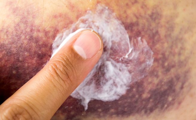 Come curare gli ematomi