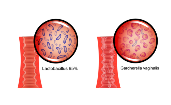 Gardnerella: i rimedi per prevenire l'infezione