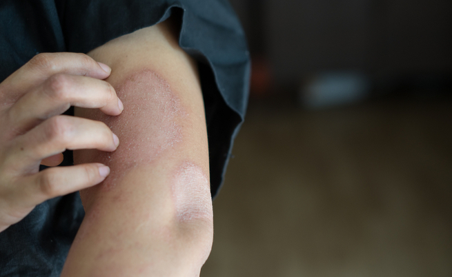 Prurito notturno: spesso la causa è da ricercarsi in malattie dermatologiche