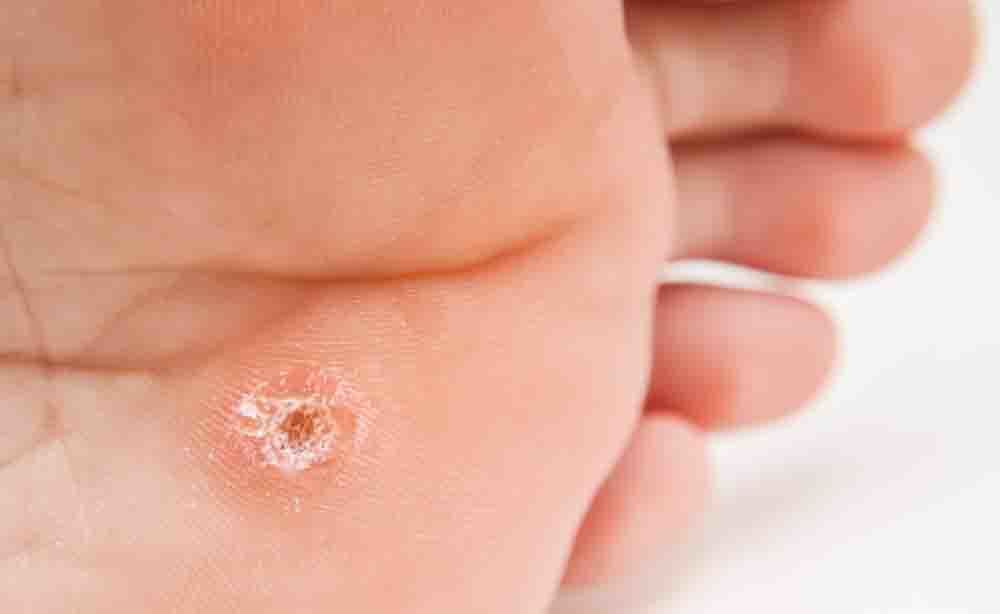 verruca: come eliminarla