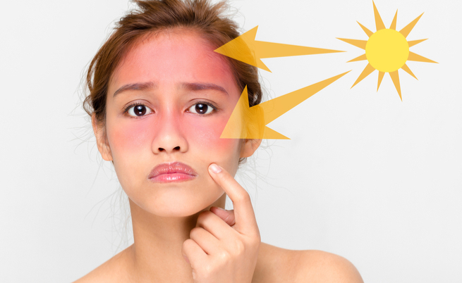 Scottature: ecco i rimedi per alleviare i sintomi del rossore causato dal sole