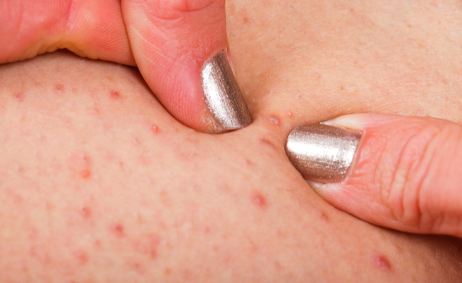 Follicolite: cause, sintomi e rimedi naturali per la follicolite da depilazione