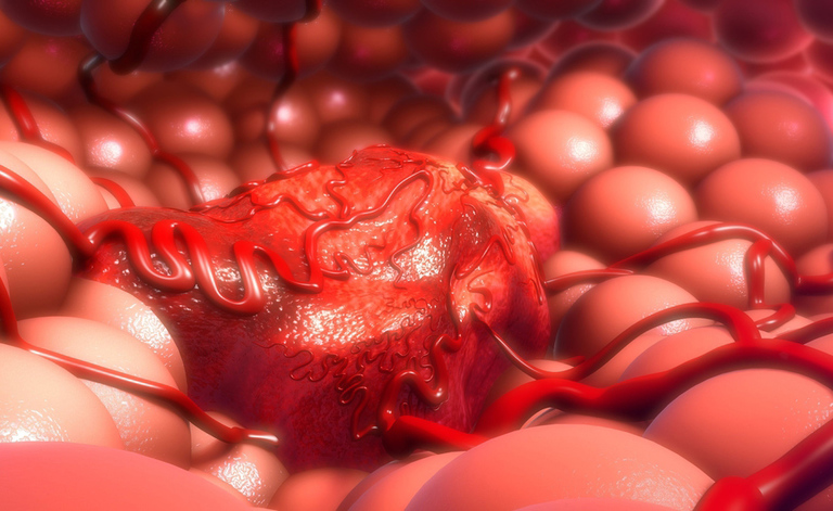 tumore: la diagnosi precoce