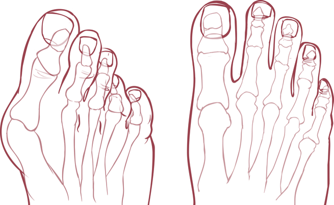 alluce valgo : prima e dopo l'intervento