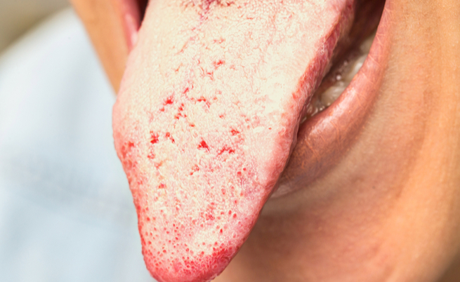 candida orale: sintomi, cause e rimedi naturali