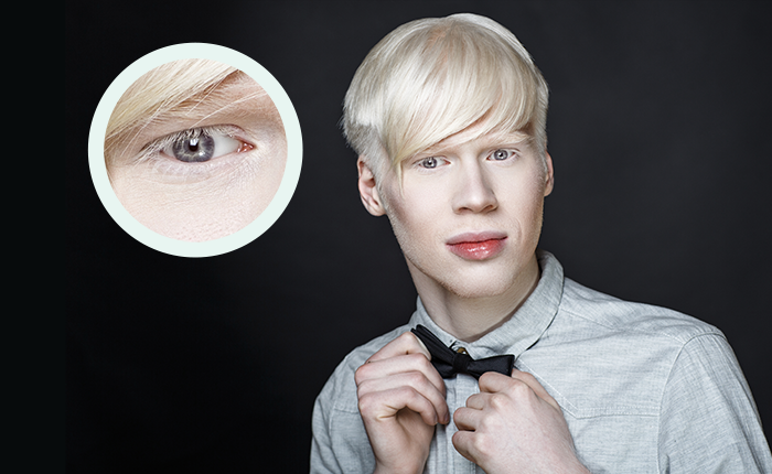 Albinismo oculare: i sintomi e le cause