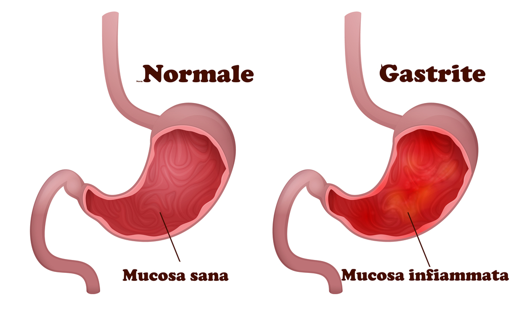 gastrite: curarla con lo zenzero