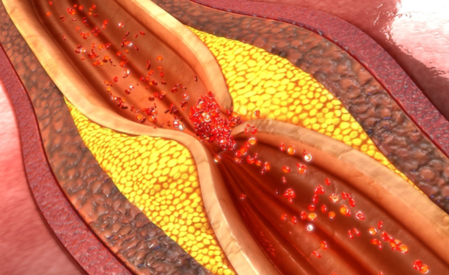 Insufficienza cardiaca: le cause più comuni