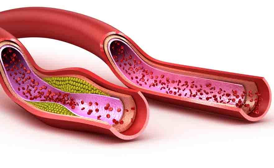 colesterolo alto: i rimedi naturali