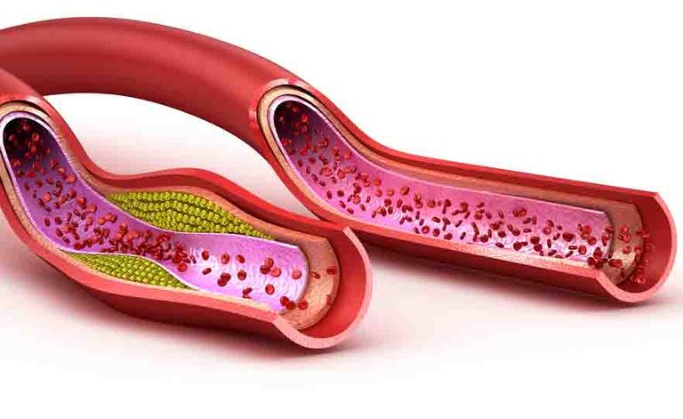 colesterolo alto: i rimedi naturali