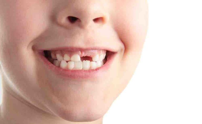 piorrea: può essere causata dallo stress?