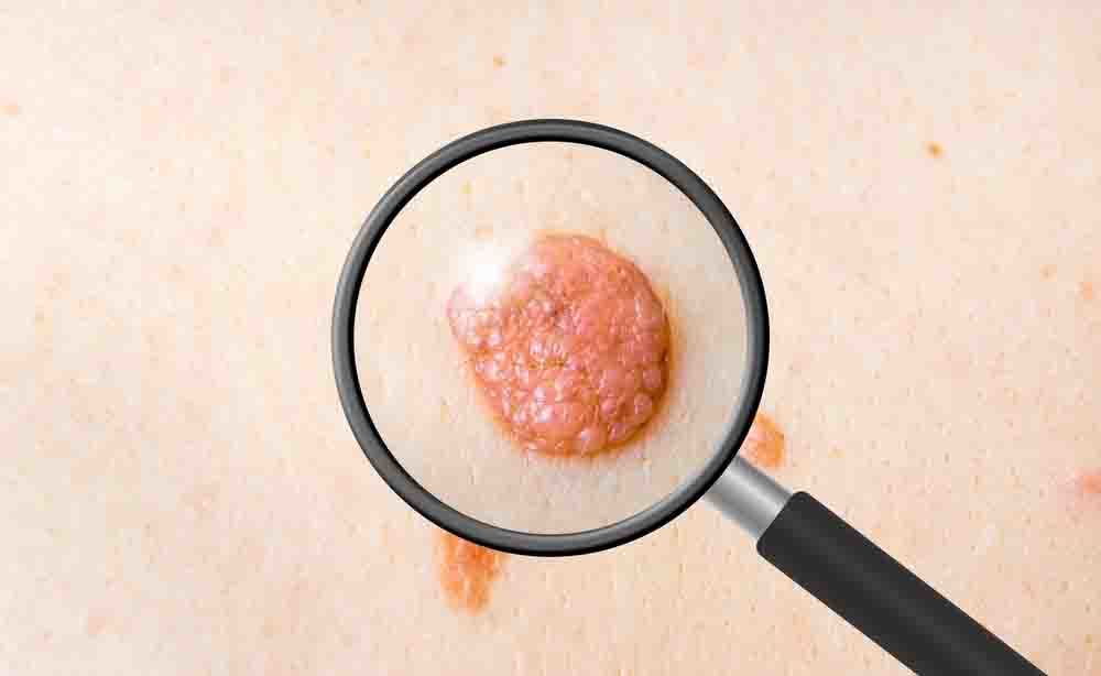 tumore della pelle: i fattori di rischio del melanoma