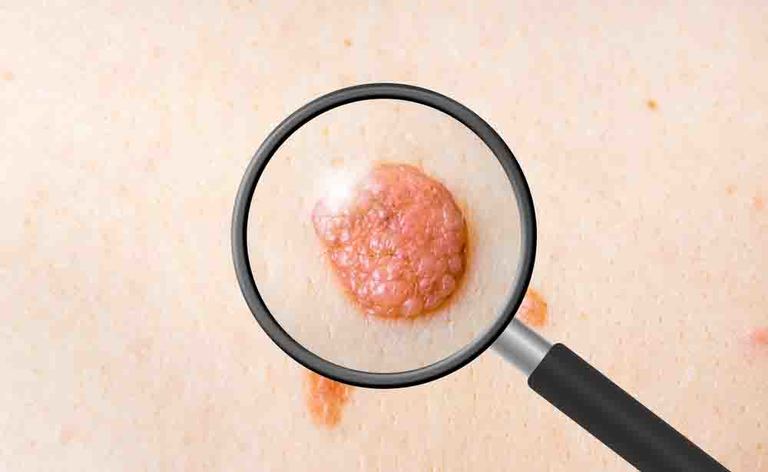 tumore della pelle: i fattori di rischio del melanoma