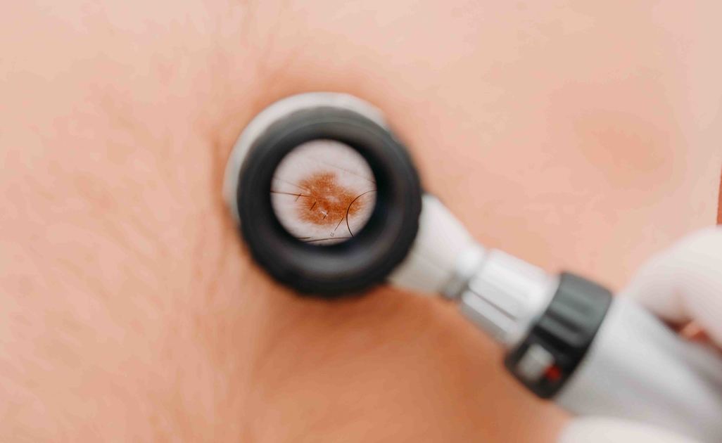 tumore alla pelle: la tecnica di diagnosi (ABCDE)