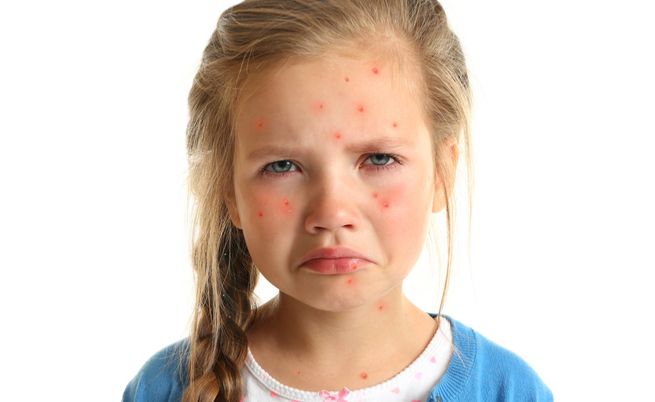 Varicella: periodo di incubazione e sintomi