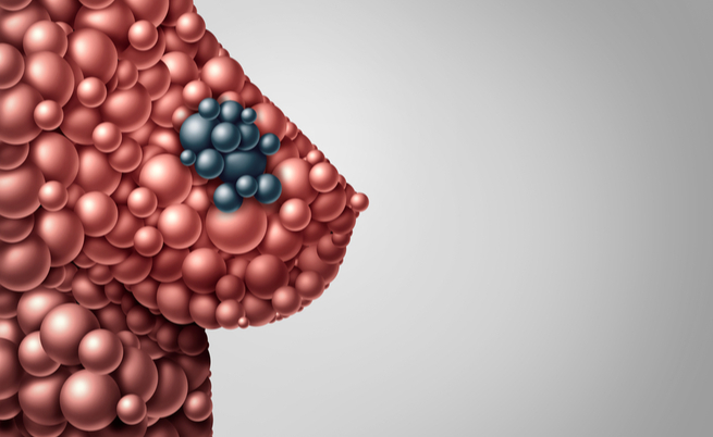 Tumore al seno: sintomi e classificazione