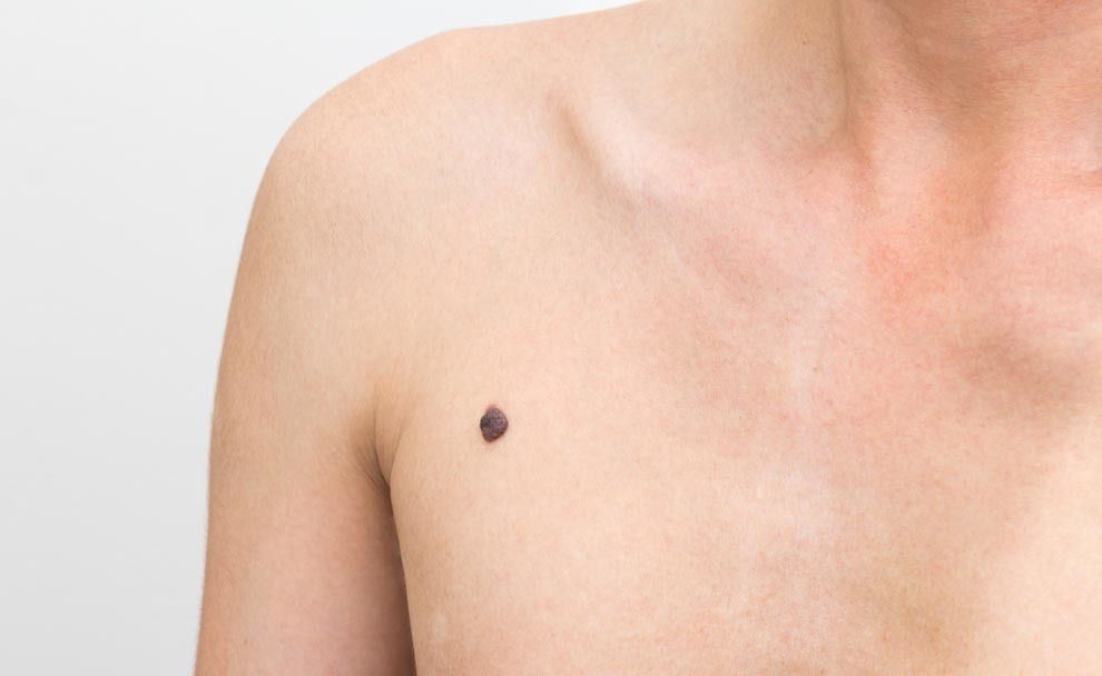 melanoma: quando un neo è un tumore