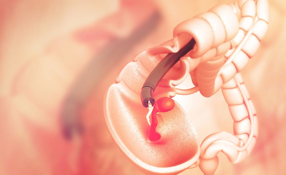 colonscopia magnetica: una nuova procedura per l'esame del colon