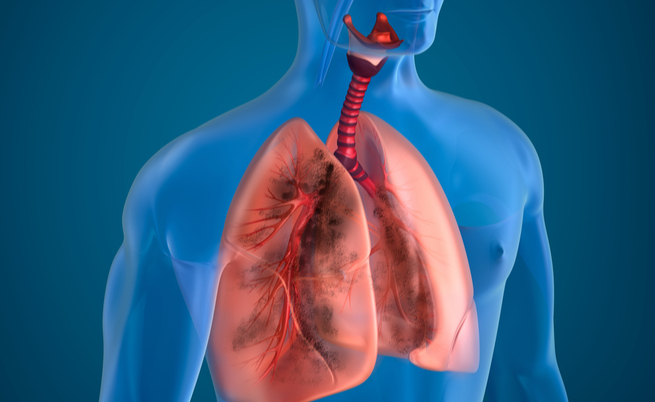 Tumori ai polmoni: ecco una nuova diagnosi