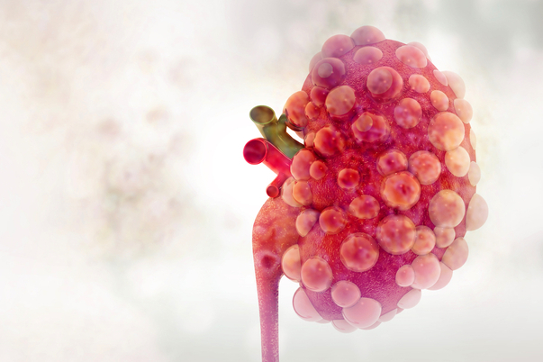 Rene policistico: nuovo farmaco