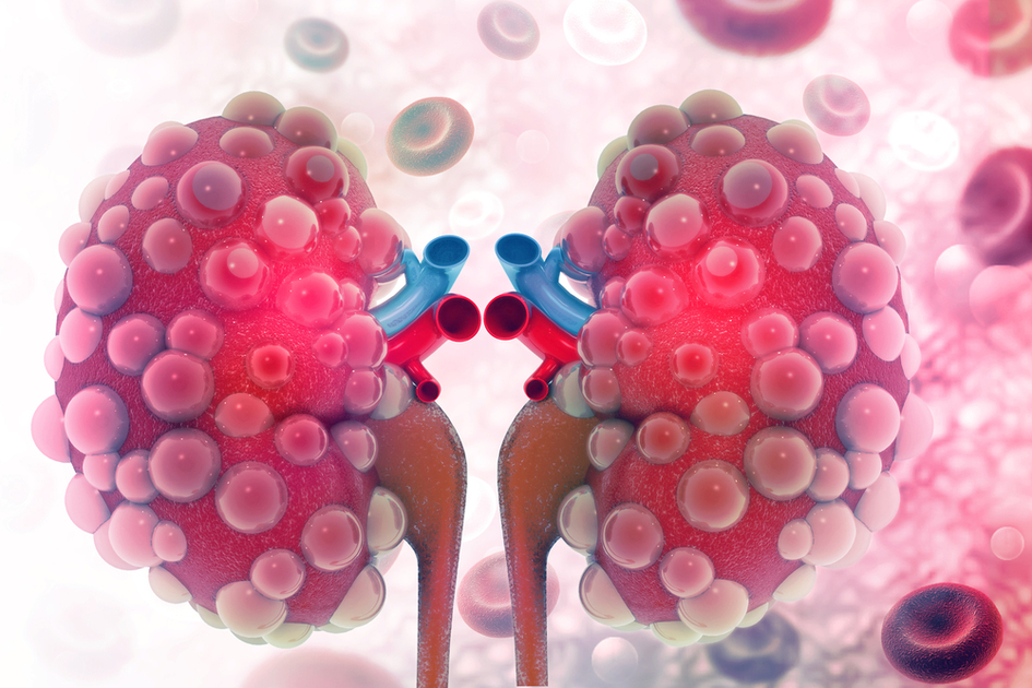 Ferritina e malattie renali croniche