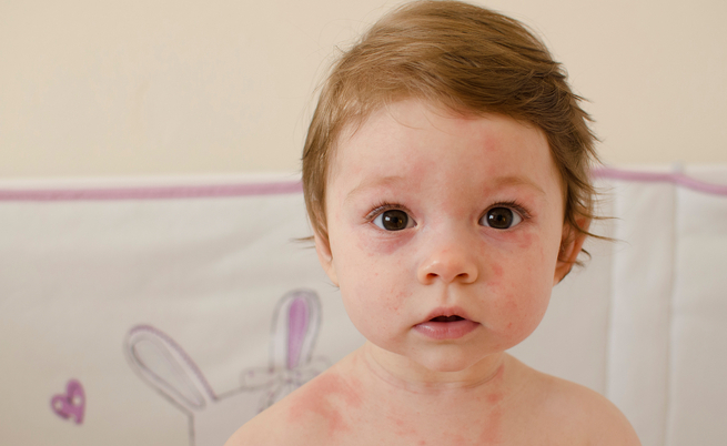 Sesta malattia, come riconoscerla