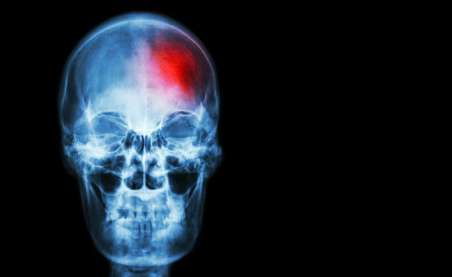 Ictus, il trattamento immediato