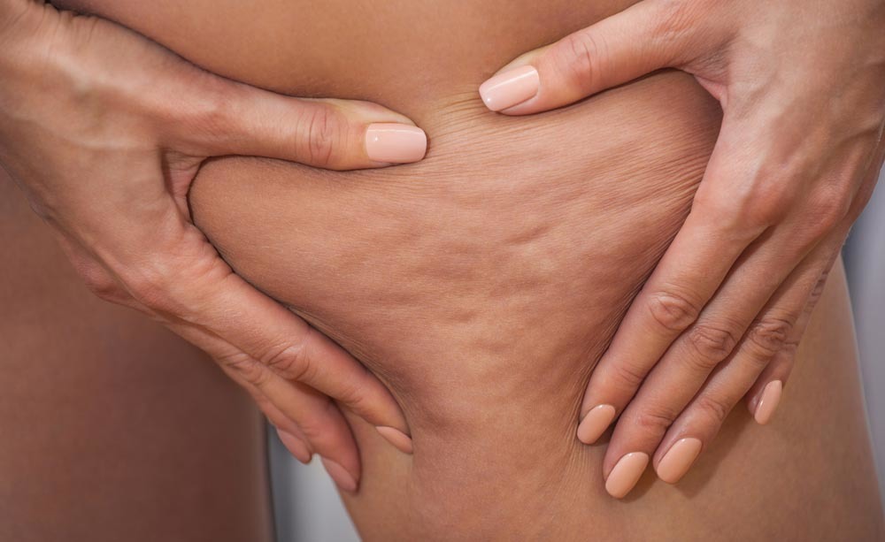 cellulite: i rimedi naturali