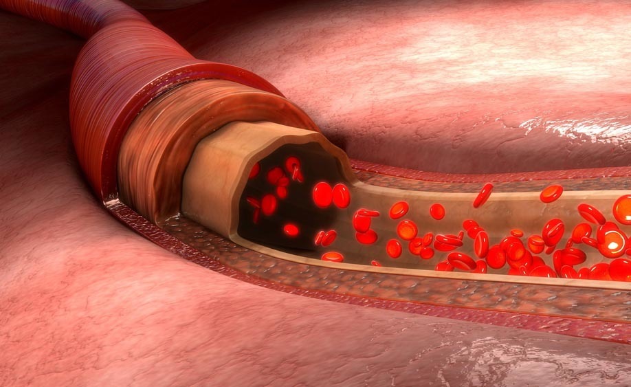 pressione alta: i rimedi naturali con le erbe