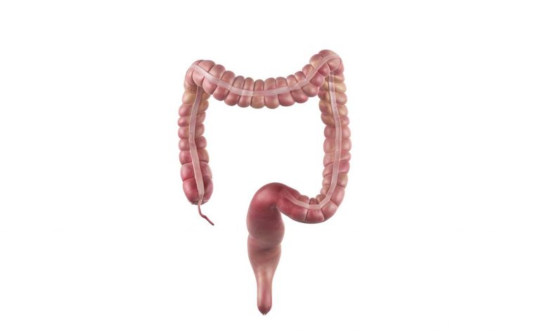 Asportazione del colon: le conseguenze per la salute