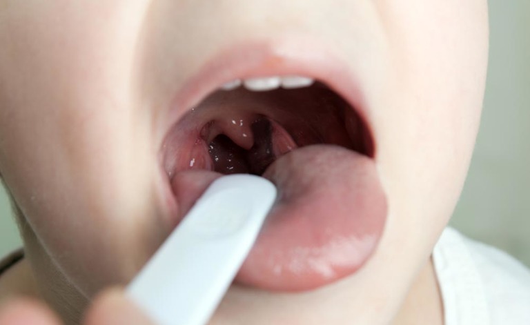 tonsillite: le cause scatenanti e le cure