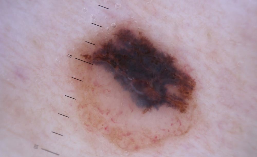 melanoma: cause, sintomi e terapie