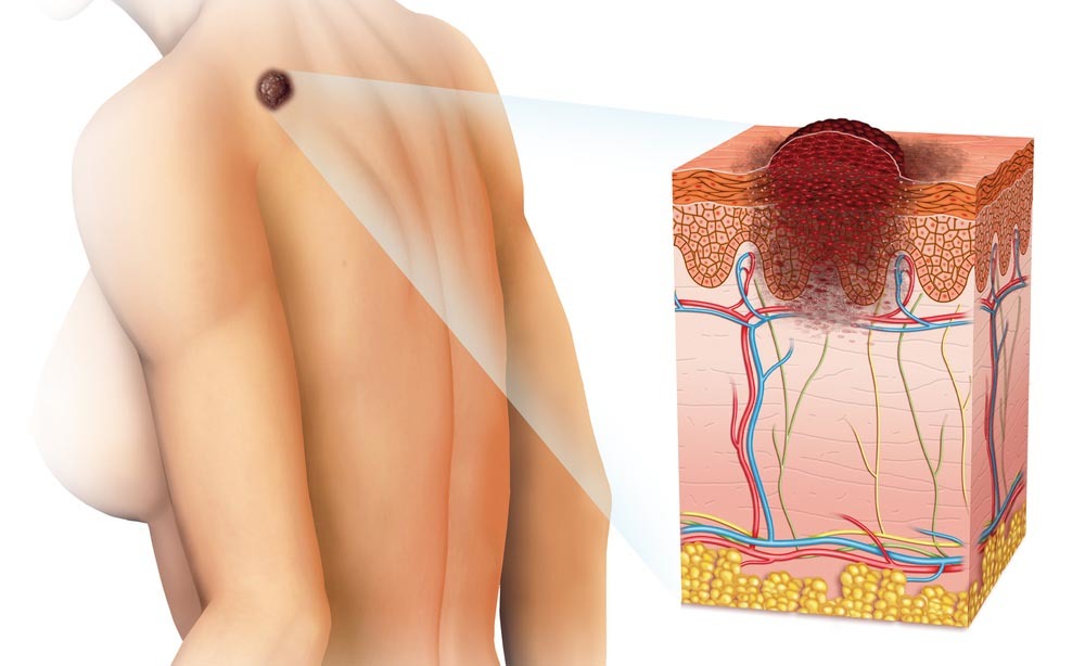 tumore della pelle: come prevenirlo