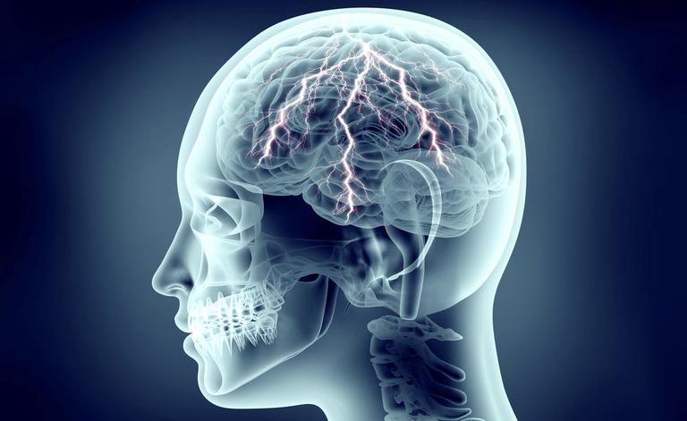 vasi linfatici cerebrali