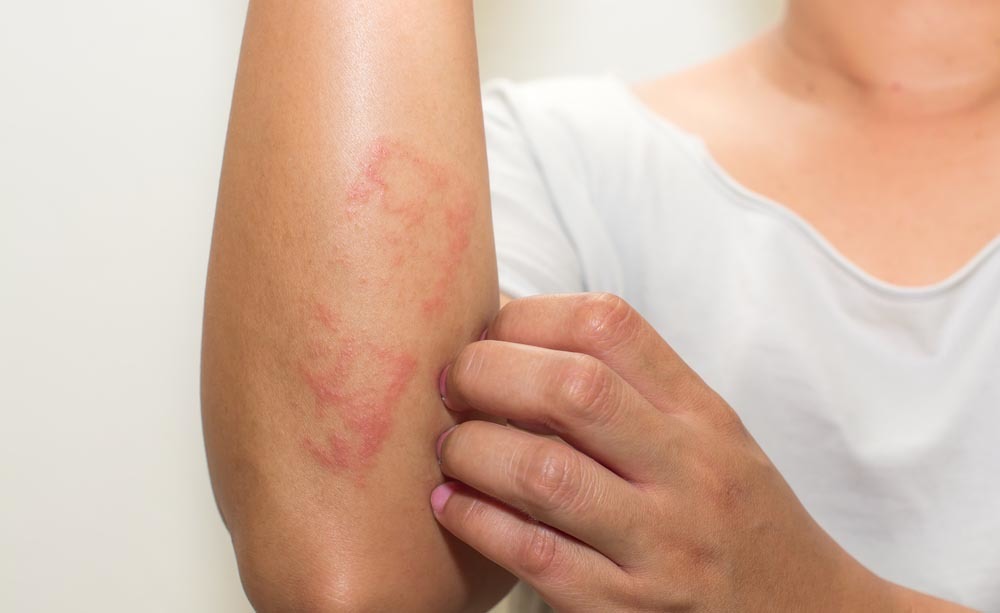 Psoriasi e dermatite seborroica: le differenze