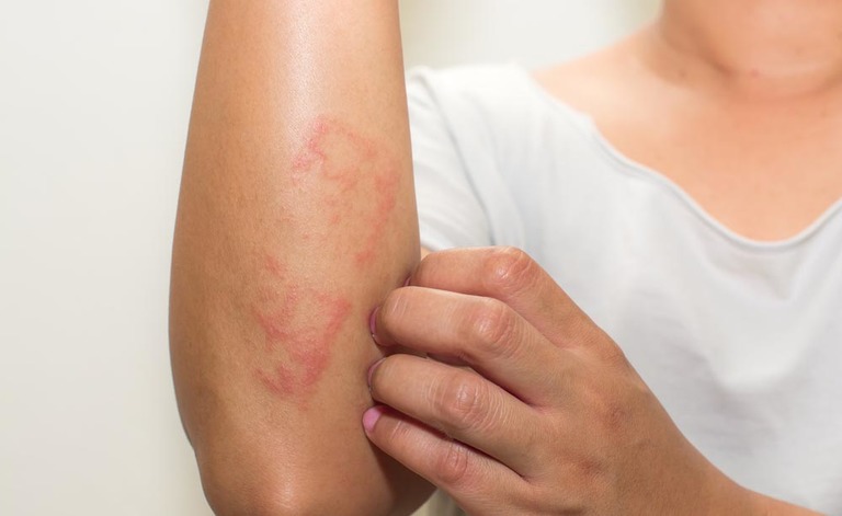 Psoriasi e dermatite seborroica: le differenze