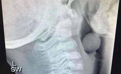 acino d'uva: i rischi per i bambini