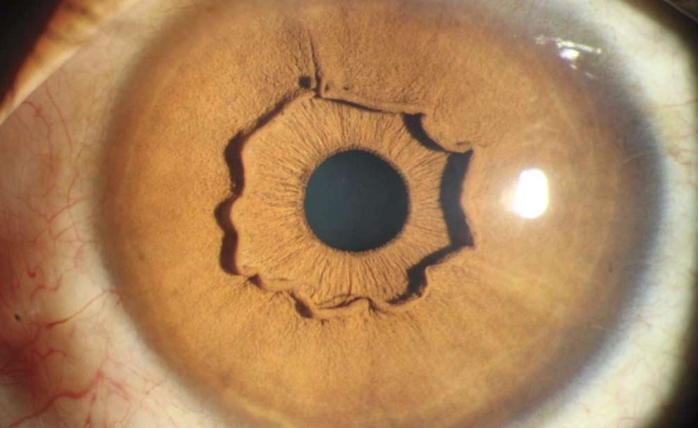 collaretto dell'occhio: la storia di una donna con una anomalia
