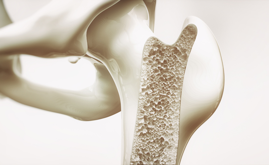 osteoporosi: le cause e come prevenirla