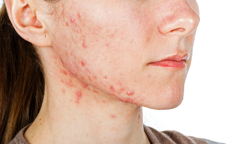 acne: vediamo insieme allo specialista quali sono i rimedi per l'acne