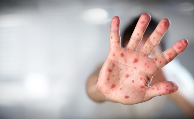 morbillo: i rischi per la salute