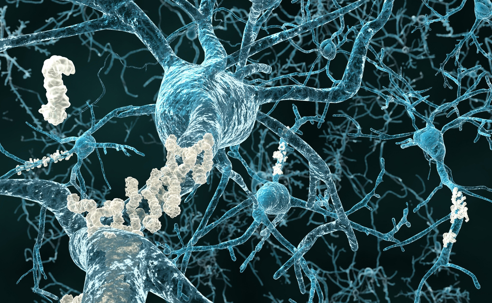 morbo di alzheimer: scoperta l'origine della malattia nella dopamina