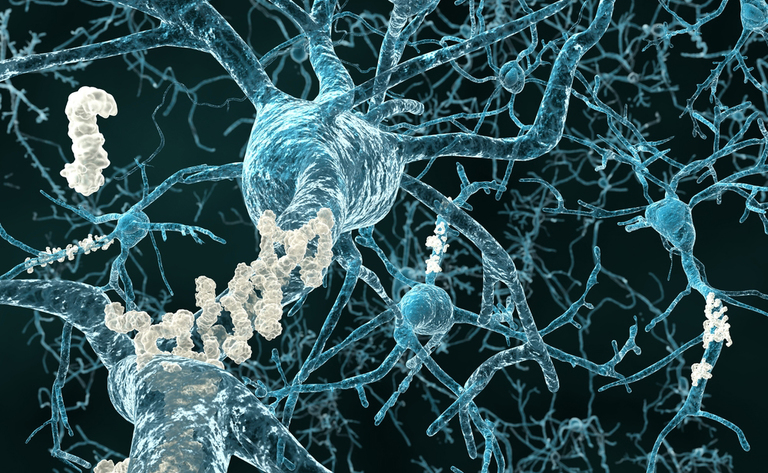 morbo di alzheimer: scoperta l'origine della malattia nella dopamina