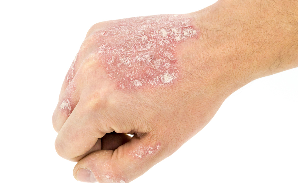 psoriasi: 10 alimenti consigliati per stare meglio